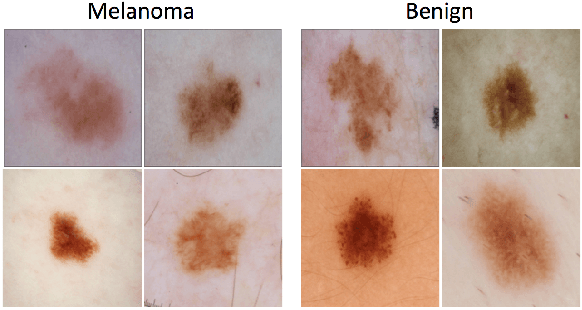 Figure 4 for Skin Lesion Analysis Toward Melanoma Detection: A Challenge at the 2017 International Symposium on Biomedical Imaging (ISBI), Hosted by the International Skin Imaging Collaboration (ISIC)