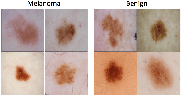 Figure 4 for Skin Lesion Analysis Toward Melanoma Detection: A Challenge at the 2017 International Symposium on Biomedical Imaging , Hosted by the International Skin Imaging Collaboration