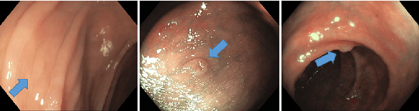 Figure 1 for Diagnosing Colorectal Polyps in the Wild with Capsule Networks