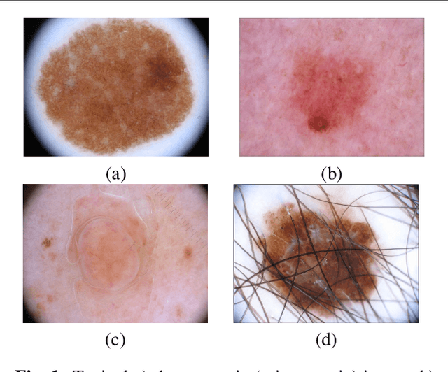 Figure 1 for Comparative Analysis of Automatic Skin Lesion Segmentation with Two Different Implementations