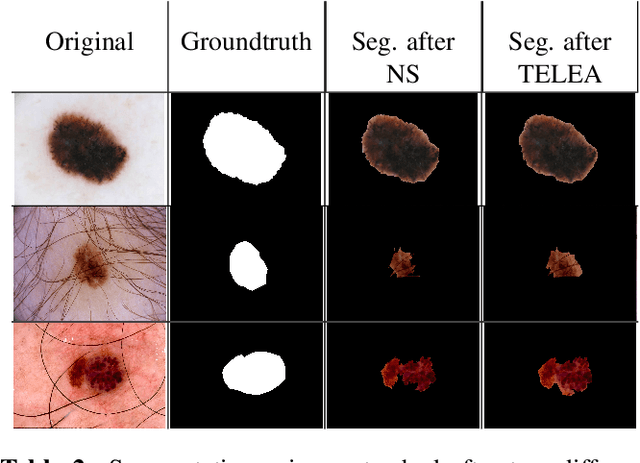 Figure 4 for Comparative Analysis of Automatic Skin Lesion Segmentation with Two Different Implementations