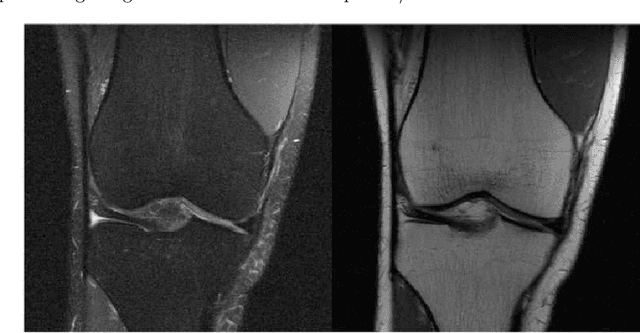 Figure 2 for A Deep Learning Approach Using Masked Image Modeling for Reconstruction of Undersampled K-spaces