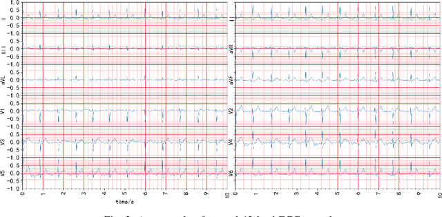 Figure 3 for MLBF-Net: A Multi-Lead-Branch Fusion Network for Multi-Class Arrhythmia Classification Using 12-Lead ECG