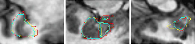 Figure 3 for Dilated deeply supervised networks for hippocampus segmentation in MRI