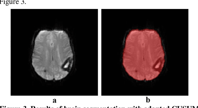 Figure 3 for CUSUM Filter for Brain Segmentation on DSC Perfusion MR Head Scans with Abnormal Brain Anatomy