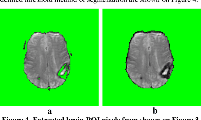 Figure 4 for CUSUM Filter for Brain Segmentation on DSC Perfusion MR Head Scans with Abnormal Brain Anatomy