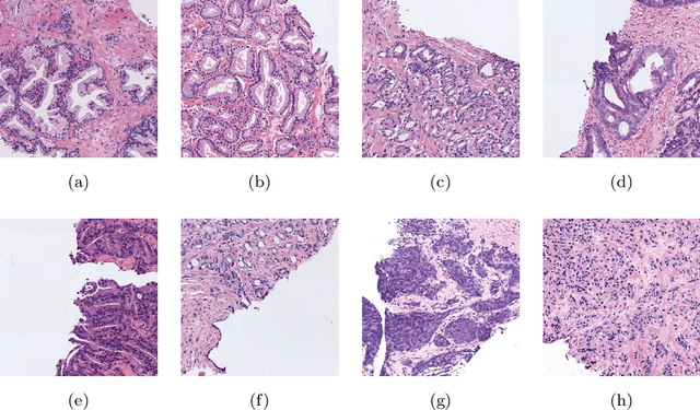 Figure 1 for Going Deeper through the Gleason Scoring Scale: An Automatic end-to-end System for Histology Prostate Grading and Cribriform Pattern Detection