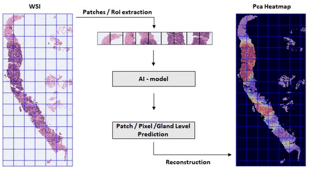 Figure 3 for Going Deeper through the Gleason Scoring Scale: An Automatic end-to-end System for Histology Prostate Grading and Cribriform Pattern Detection