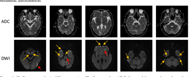 Figure 1 for Automatic acute ischemic stroke lesion segmentation using semi-supervised learning
