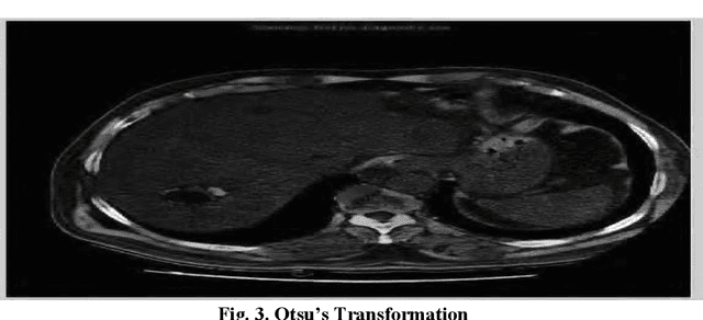 Figure 2 for Analysis of liver cancer detection based on image processing