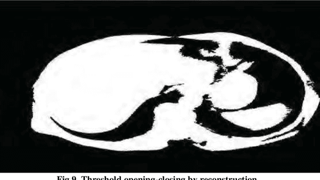 Figure 3 for Analysis of liver cancer detection based on image processing