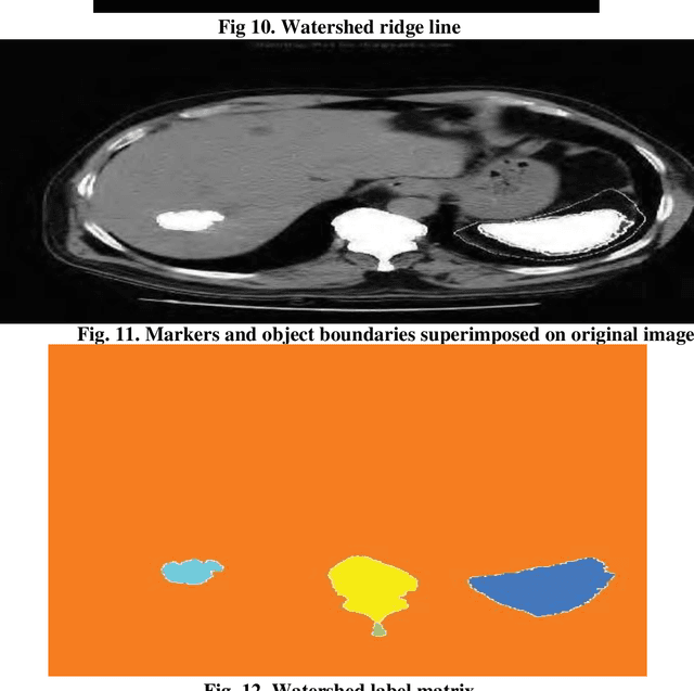 Figure 4 for Analysis of liver cancer detection based on image processing