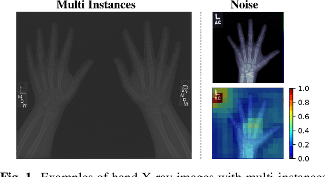 Figure 1 for Residual Attention based Network for Hand Bone Age Assessment