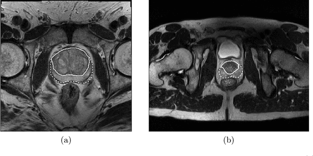 Figure 1 for CNN-based Prostate Zonal Segmentation on T2-weighted MR Images: A Cross-dataset Study