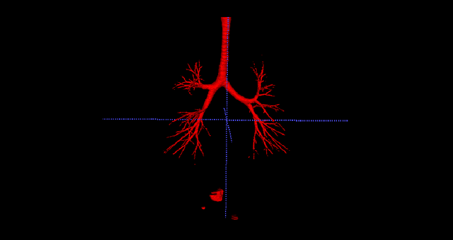 Figure 2 for A CT-Based Airway Segmentation Using U$^2$-net Trained by the Dice Loss Function