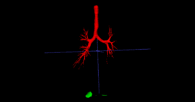 Figure 3 for A CT-Based Airway Segmentation Using U$^2$-net Trained by the Dice Loss Function