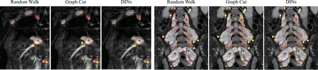 Figure 2 for DINs: Deep Interactive Networks for Neurofibroma Segmentation in Neurofibromatosis Type 1 on Whole-Body MRI