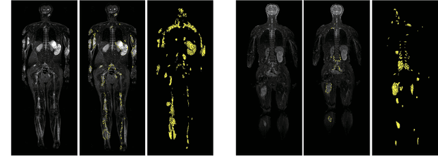 Figure 1 for DINs: Deep Interactive Networks for Neurofibroma Segmentation in Neurofibromatosis Type 1 on Whole-Body MRI