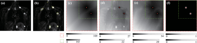 Figure 4 for DINs: Deep Interactive Networks for Neurofibroma Segmentation in Neurofibromatosis Type 1 on Whole-Body MRI