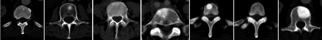 Figure 1 for Detection of Sclerotic Spine Metastases via Random Aggregation of Deep Convolutional Neural Network Classifications