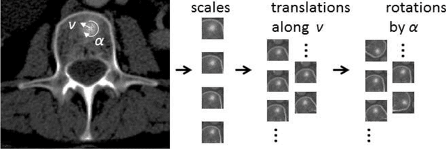 Figure 2 for Detection of Sclerotic Spine Metastases via Random Aggregation of Deep Convolutional Neural Network Classifications