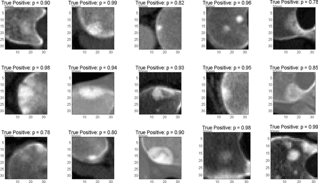 Figure 4 for Detection of Sclerotic Spine Metastases via Random Aggregation of Deep Convolutional Neural Network Classifications