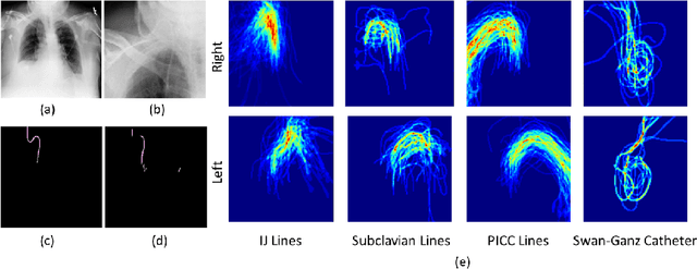 Figure 1 for Automated Detection and Type Classification of Central Venous Catheters in Chest X-Rays