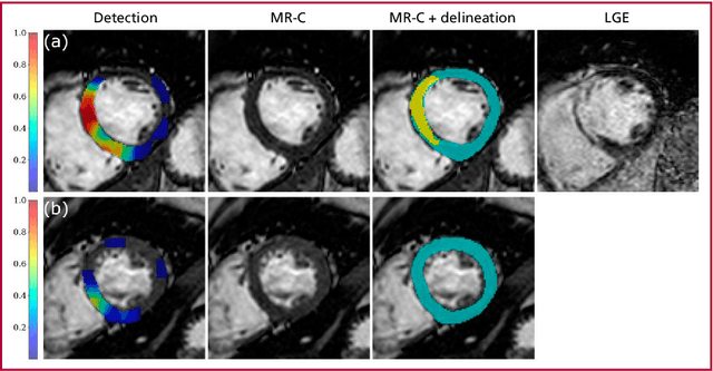 Figure 2 for Detection of Fibrosis in Cine Magnetic Resonance Images Using Artificial Intelligence Techniques