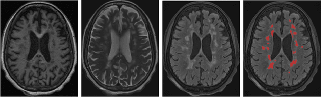Figure 1 for RSANet: Recurrent Slice-wise Attention Network for Multiple Sclerosis Lesion Segmentation
