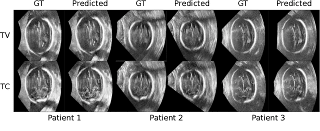 Figure 4 for Standard Plane Detection in 3D Fetal Ultrasound Using an Iterative Transformation Network
