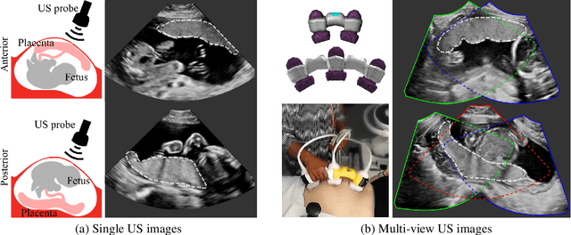 Figure 1 for Placenta Segmentation in Ultrasound Imaging: Addressing Sources of Uncertainty and Limited Field-of-View