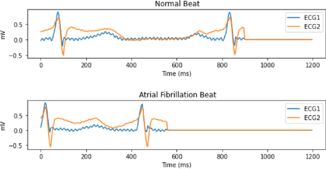 Figure 3 for Automated Atrial Fibrillation Classification Based on Denoising Stacked Autoencoder and Optimized Deep Network