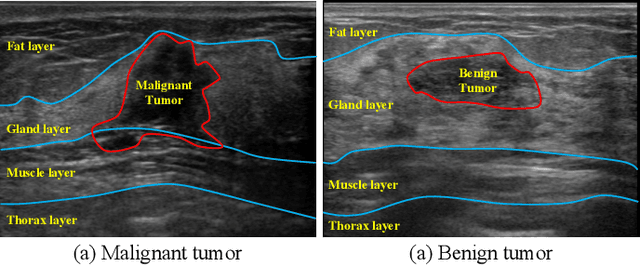 Figure 1 for HoVer-Trans: Anatomy-aware HoVer-Transformer for ROI-free Breast Cancer Diagnosis in Ultrasound Images
