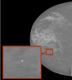 Figure 1 for Automated Detection of Individual Micro-calcifications from Mammograms using a Multi-stage Cascade Approach