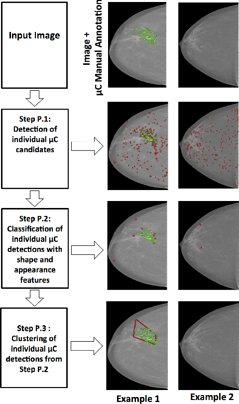 Figure 2 for Automated Detection of Individual Micro-calcifications from Mammograms using a Multi-stage Cascade Approach