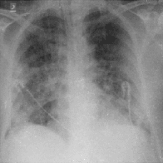 Figure 1 for CovXR: Automated Detection of COVID-19 Pneumonia in Chest X-Rays through Machine Learning