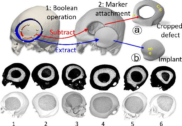 Figure 4 for A Robotic System for Implant Modification in Single-stage Cranioplasty