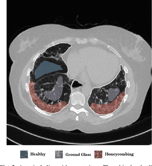 Figure 2 for Semantic Segmentation of Pathological Lung Tissue with Dilated Fully Convolutional Networks