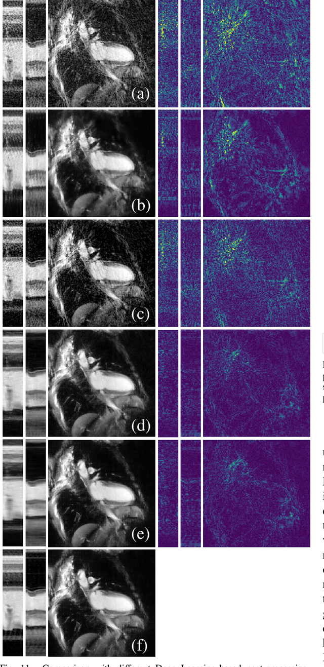 Figure 3 for Spatio-Temporal Deep Learning-Based Undersampling Artefact Reduction for 2D Radial Cine MRI with Limited Data