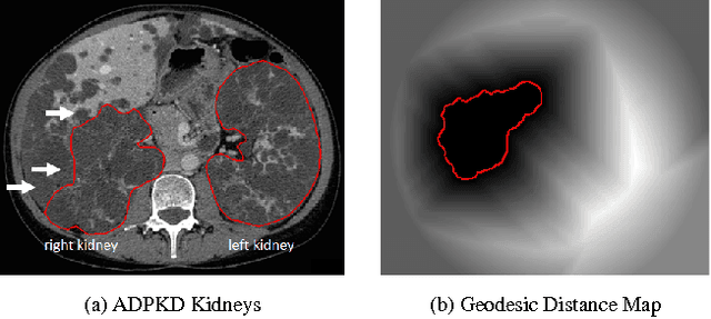 Figure 1 for Semi-Automatic Segmentation of Autosomal Dominant Polycystic Kidneys using Random Forests