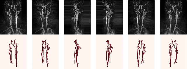 Figure 2 for Random 2.5D U-net for Fully 3D Segmentation