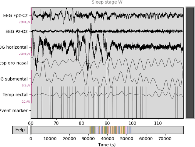 Figure 2 for Sleep syndromes onset detection based on automatic sleep staging algorithm