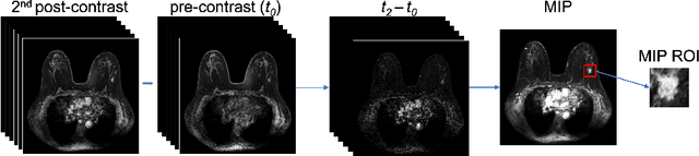 Figure 1 for Transfer Learning in 4D for Breast Cancer Diagnosis using Dynamic Contrast-Enhanced Magnetic Resonance Imaging