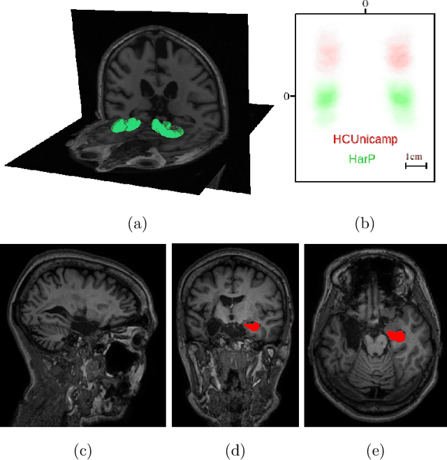 Figure 1 for Hippocampus Segmentation on Epilepsy and Alzheimer's Disease Studies with Multiple Convolutional Neural Networks