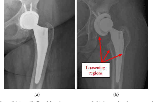 Figure 1 for Detecting mechanical loosening of total hip replacement implant from plain radiograph using deep convolutional neural network