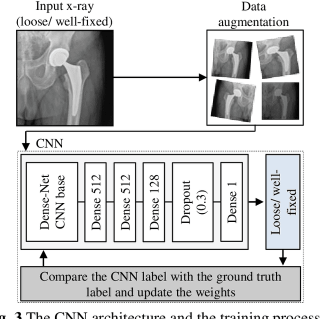 Figure 2 for Detecting mechanical loosening of total hip replacement implant from plain radiograph using deep convolutional neural network