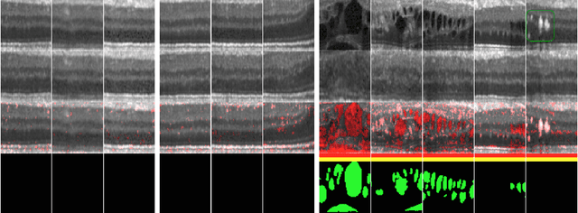 Figure 4 for Unsupervised Anomaly Detection with Generative Adversarial Networks to Guide Marker Discovery