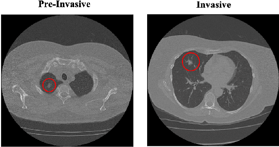 Figure 1 for CAE-Transformer: Transformer-based Model to Predict Invasiveness of Lung Adenocarcinoma Subsolid Nodules from Non-thin Section 3D CT Scans