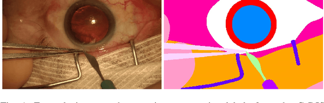 Figure 1 for CaDIS: Cataract Dataset for Image Segmentation