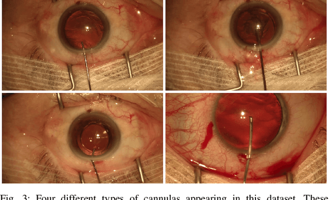 Figure 3 for CaDIS: Cataract Dataset for Image Segmentation